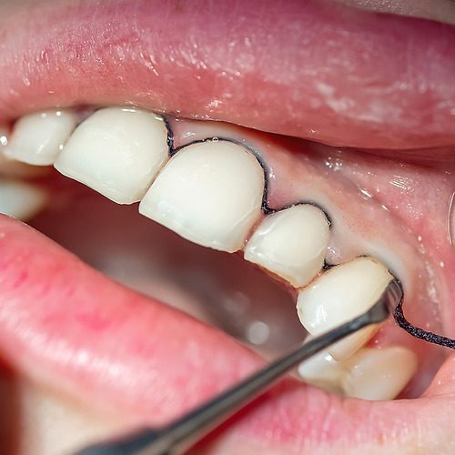 GP-Website-Category-Thumbnails-500x500-Retraction-01